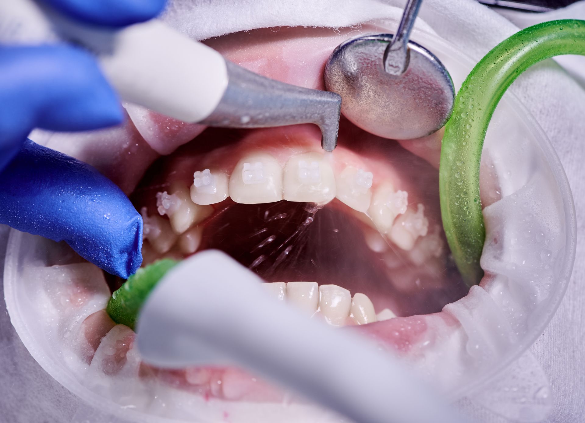 A close up of a person 's teeth being examined by a dentist.