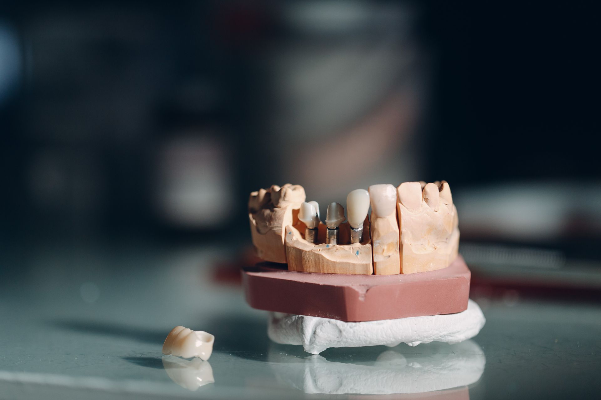 dental implants servicesin Lubbock, TX