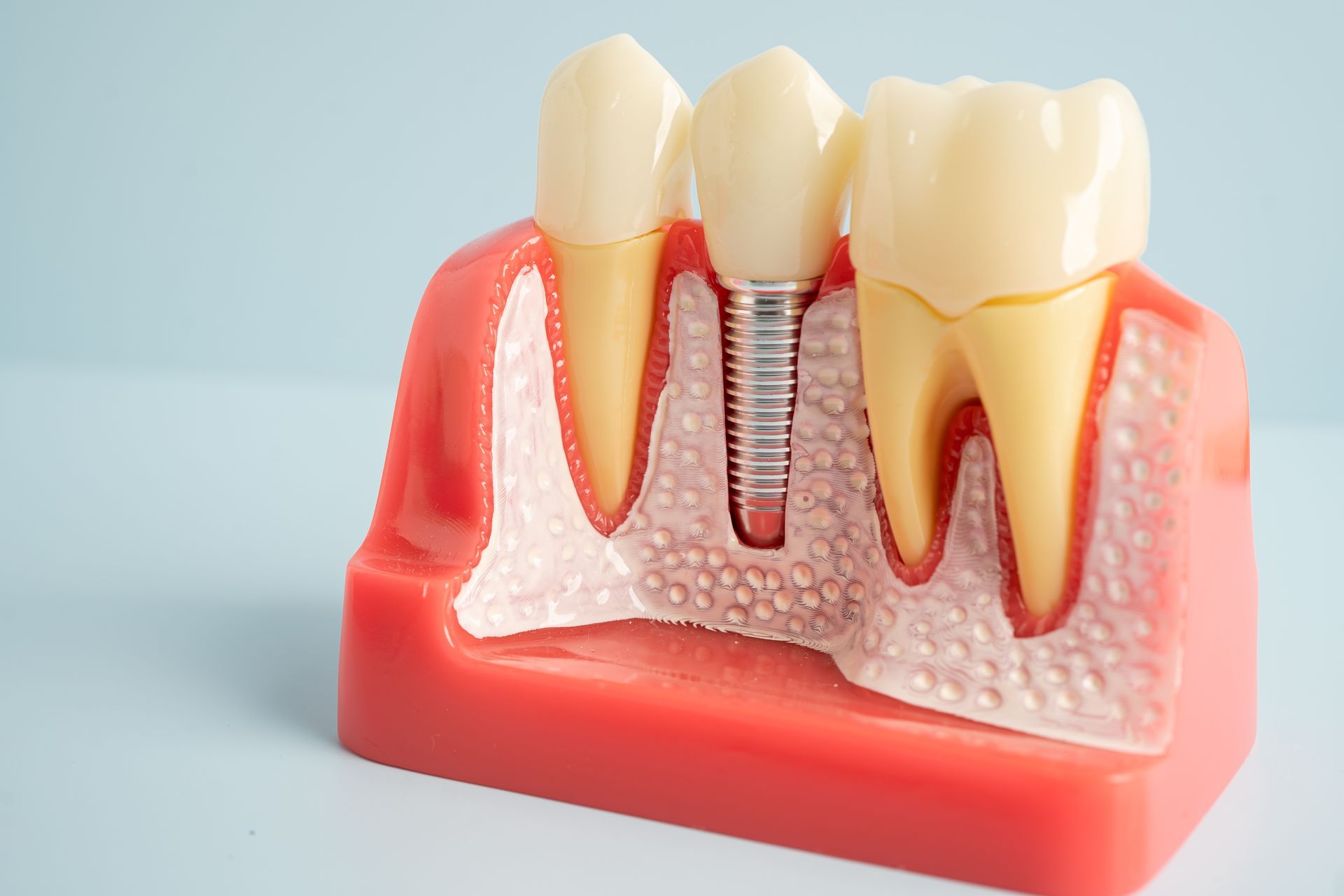 A 3d model of a dental implant in a tooth.