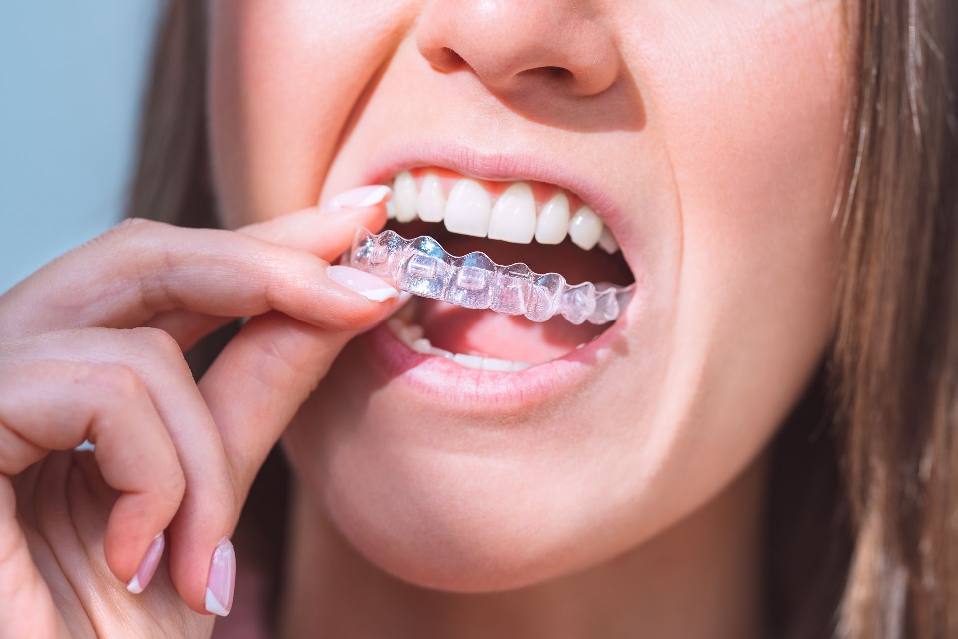 get Invisalign in Lubbock, TX