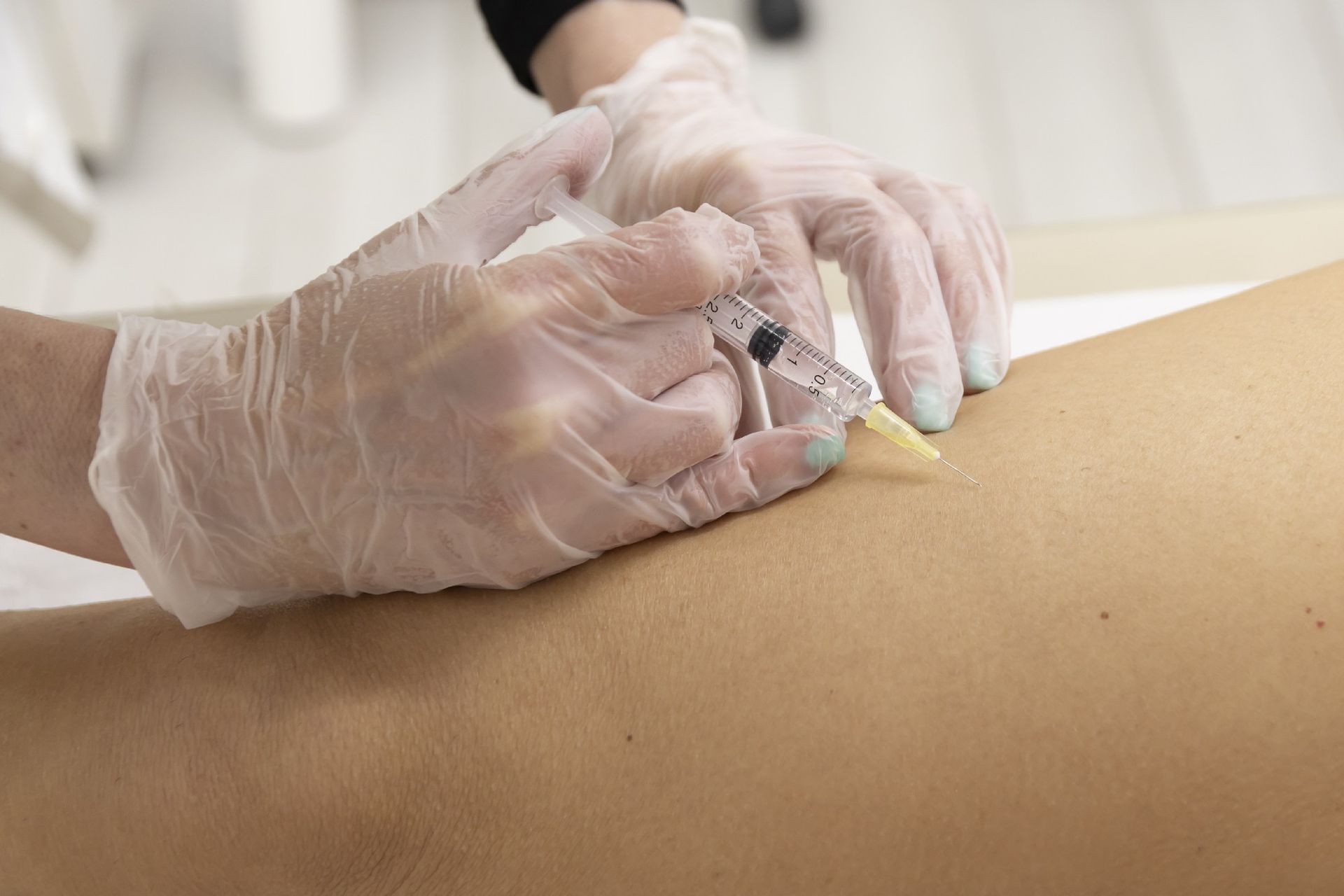 trattamenti smagliature Genova