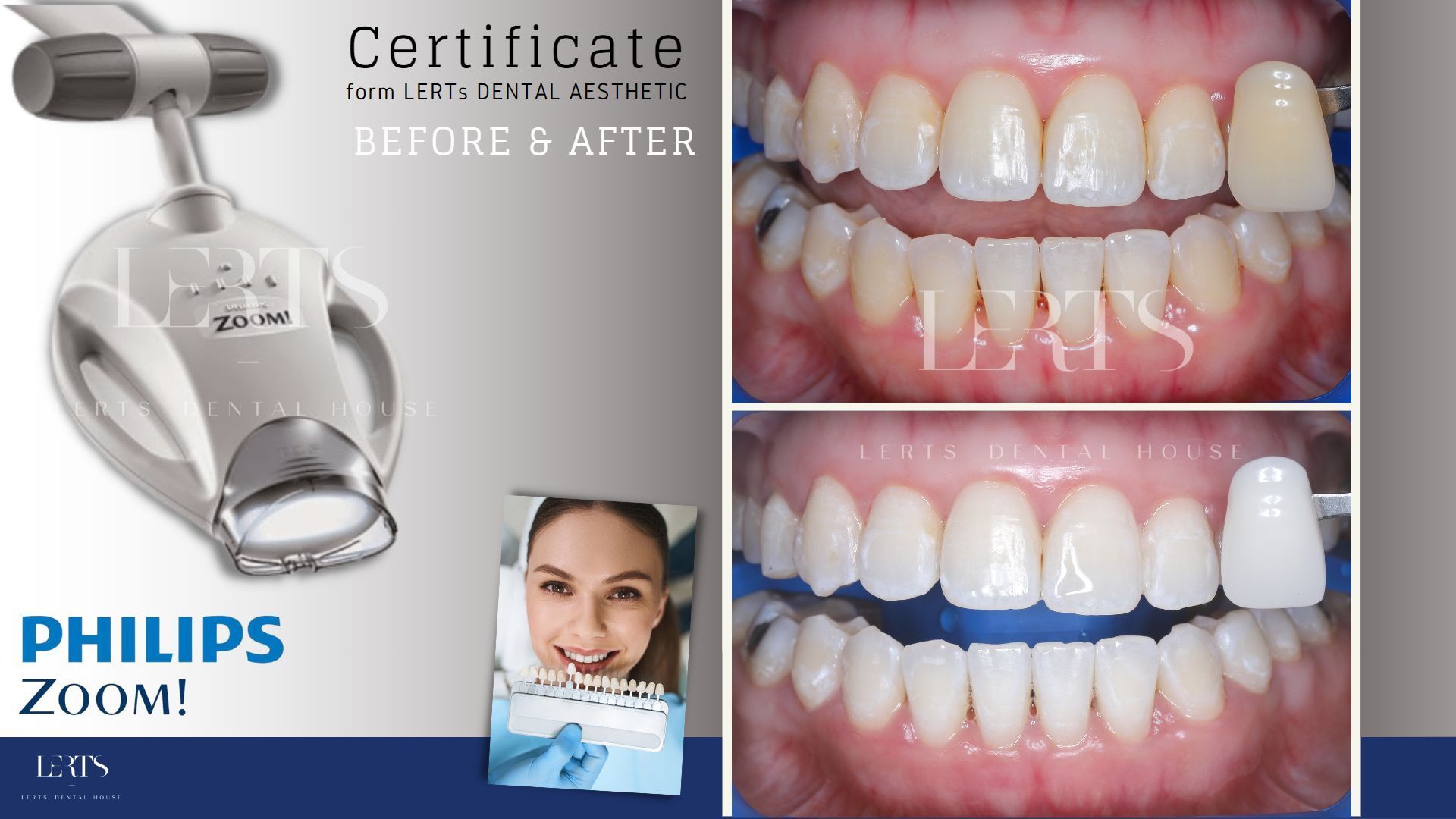 Philips Zoom whitening device and before/after photos of teeth whitening results.
