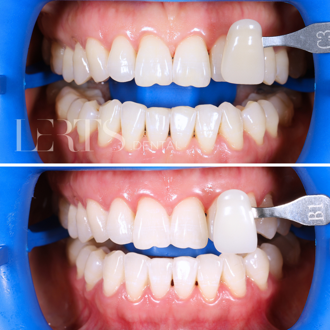 Teeth whitening comparison: before (top) and after (bottom) with shade guide indicating lighter results.