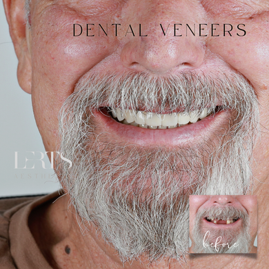 Man smiling, showing new dental veneers. Includes a small "before" photo of the natural teeth.