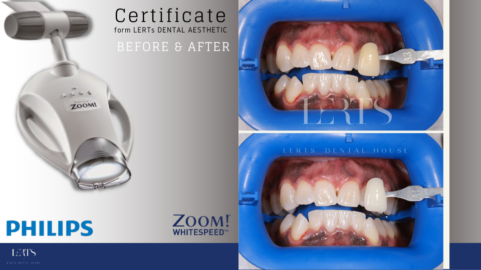 Philips Zoom teeth whitening setup: device, before/after shots of teeth with shade guide in place.
