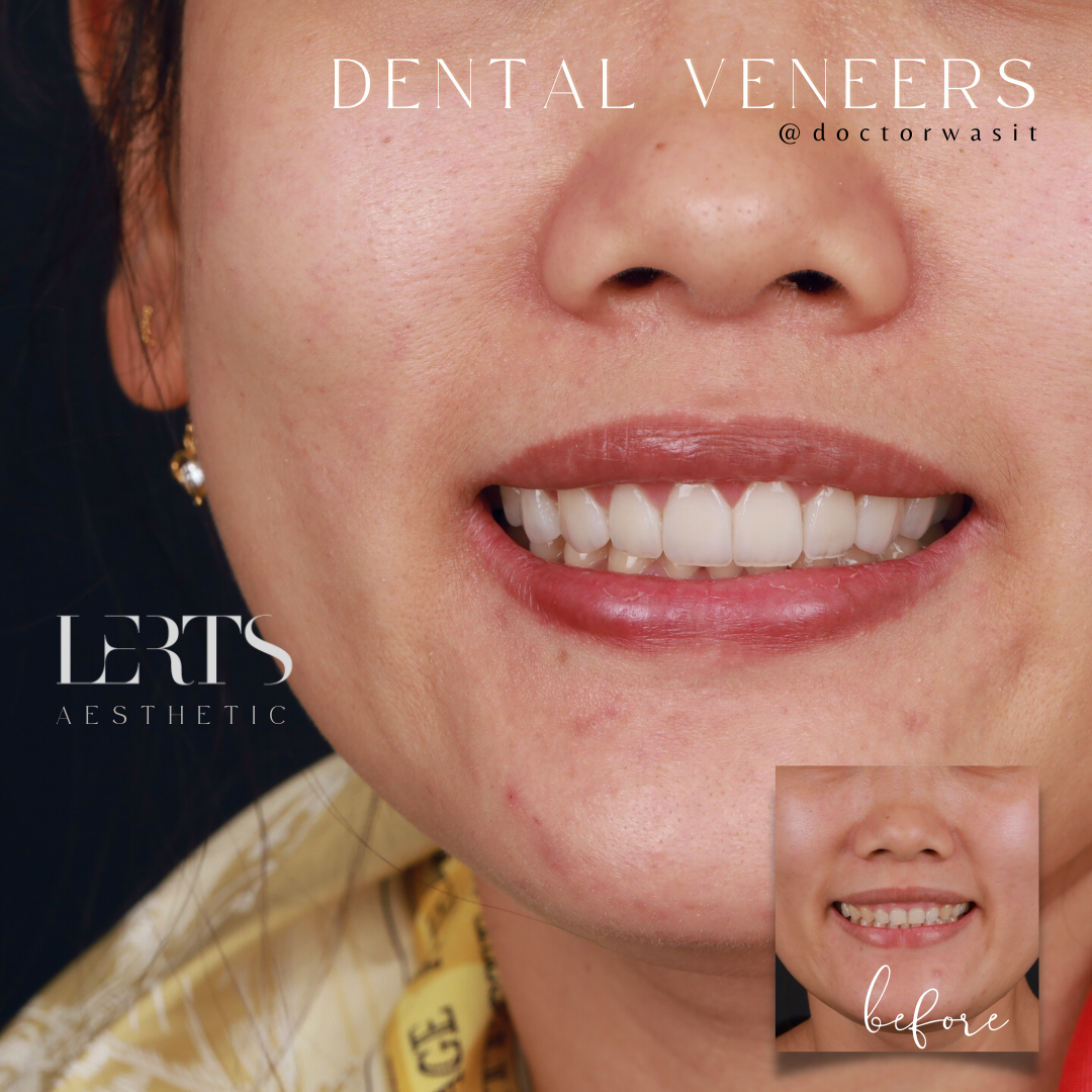 Woman's smile after dental veneers, before-and-after comparison. Improved teeth, brighter smile.