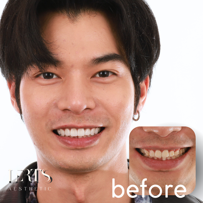 A man smiling with white teeth. Before image shows his teeth prior to cosmetic work.