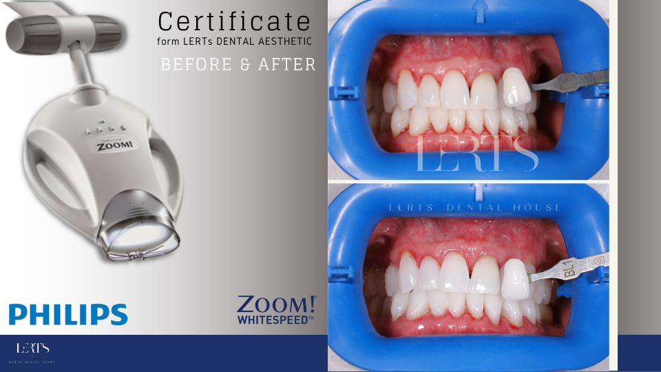 Philips Zoom Whitening machine with before/after teeth whitening comparison.