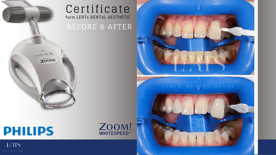 Philips Zoom teeth whitening machine with before/after teeth whitening comparison.