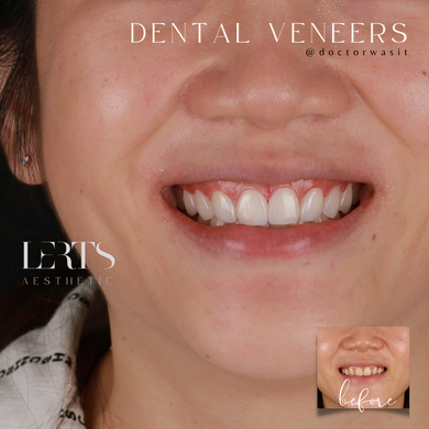 Woman's smile showcasing dental veneers; white teeth. Before photo shows the initial teeth condition.