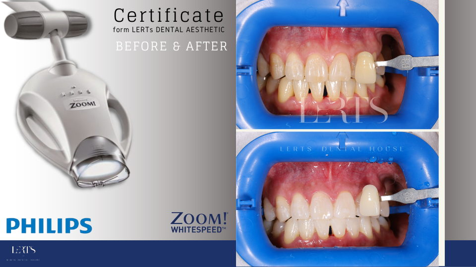 Philips Zoom teeth whitening setup showing before/after comparison and a light.