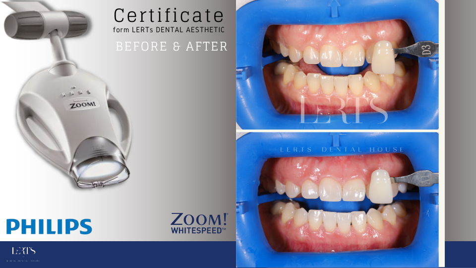 Philips Zoom teeth whitening, before and after, with lamp and brighter smile.