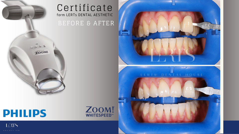 Philips Zoom whitening machine with before/after teeth whitening results.