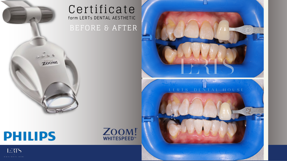 Philips Zoom! whitening system equipment with before & after teeth whitening photos.