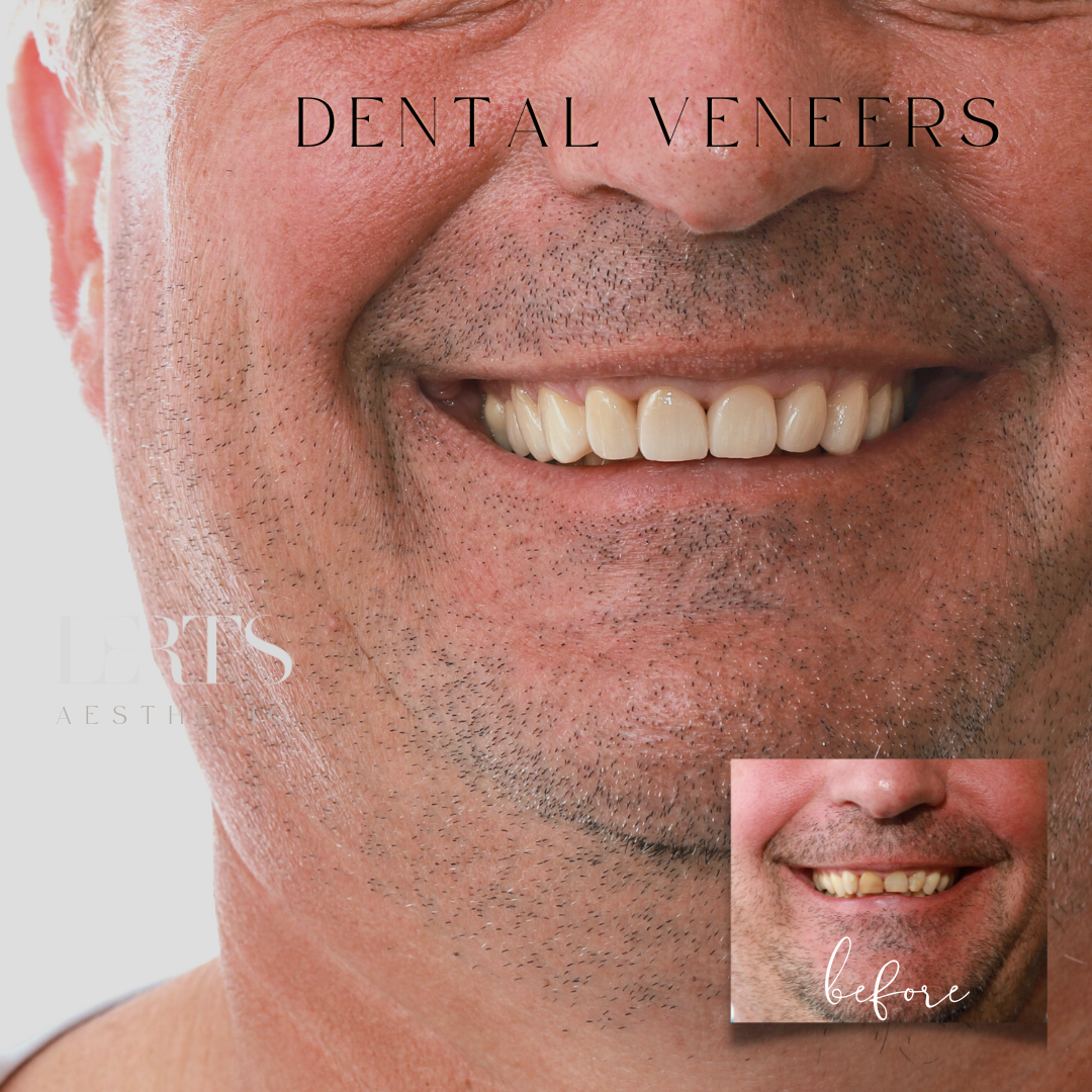 Man's smile with new white veneers, compared to before photo with discolored teeth.