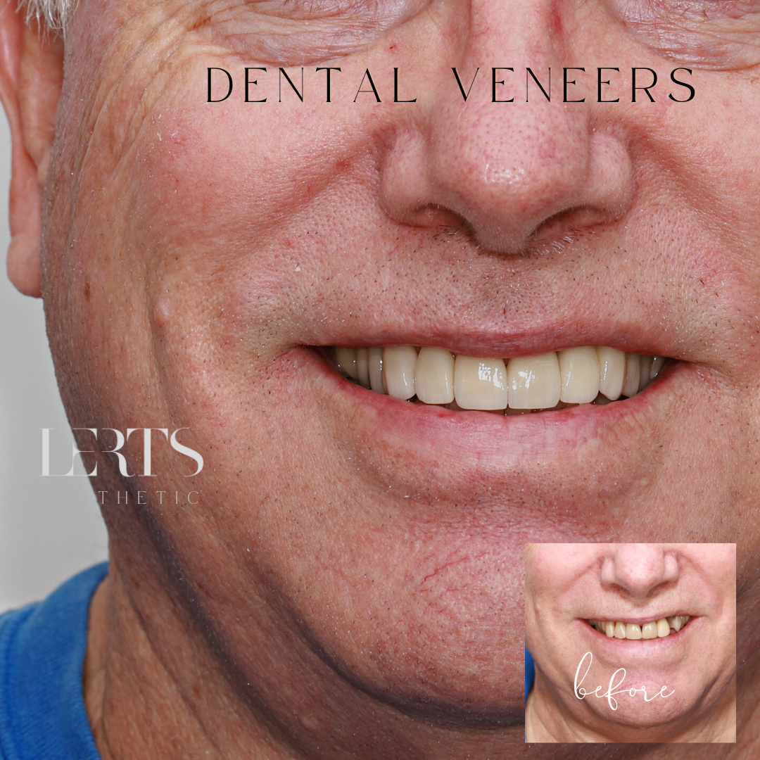 Man smiling, showcasing new dental veneers. Before/after comparison with yellowed teeth in small inset photo.