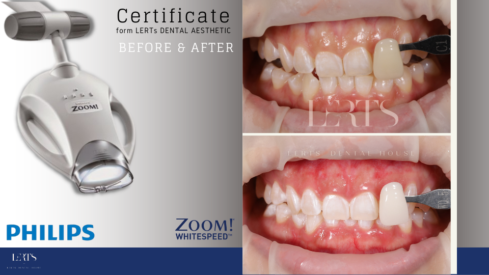 Philips Zoom whitening lamp with before & after teeth whitening comparisons.