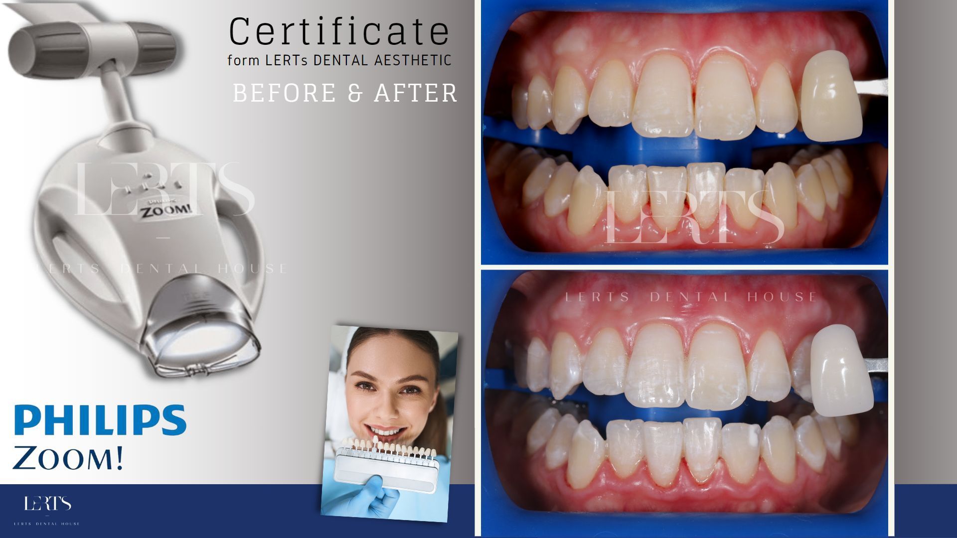 Philips Zoom teeth whitening comparison: before & after photos with machine.