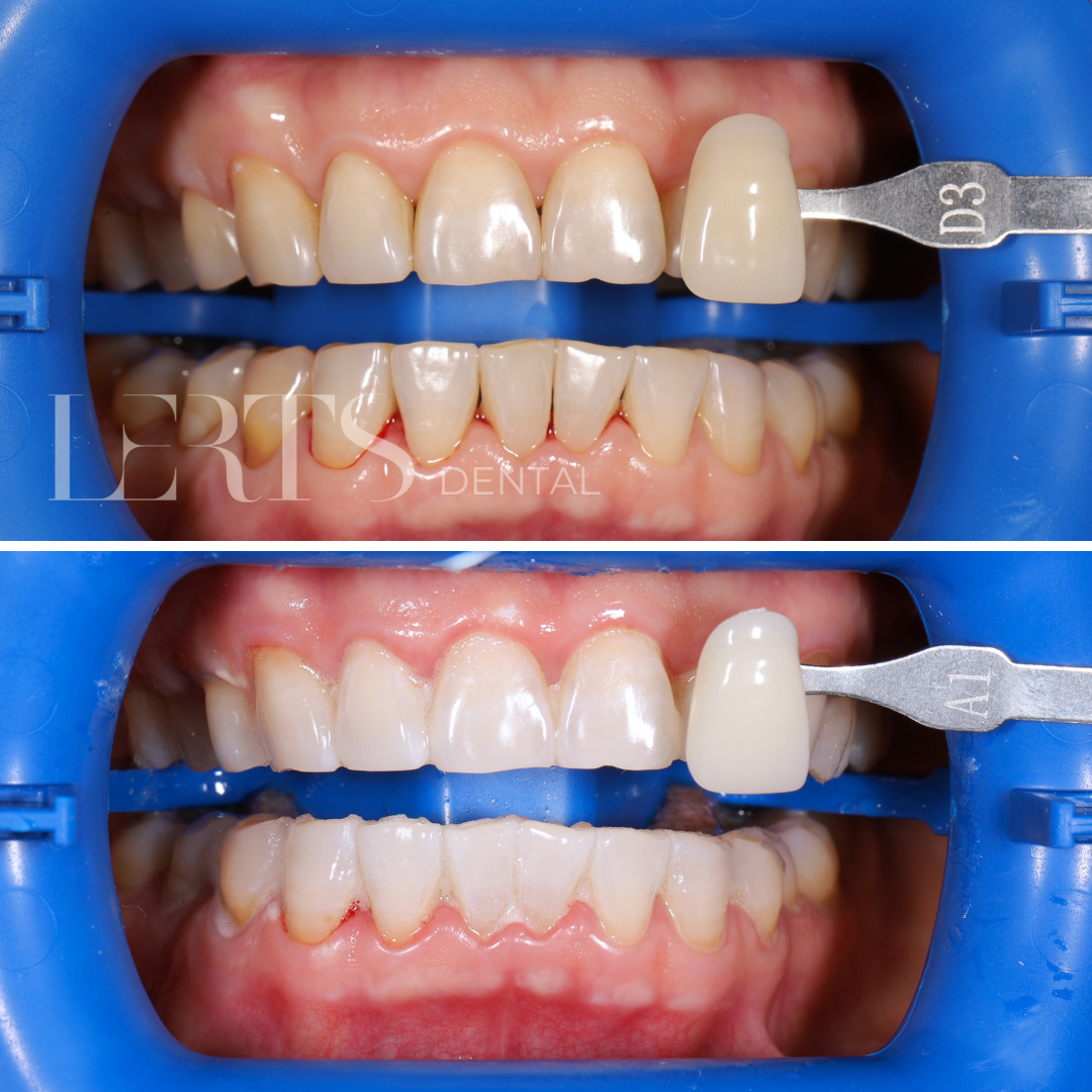 Side-by-side dental photos. Top: before, teeth yellow. Bottom: after, teeth white. Shade guide comparison.