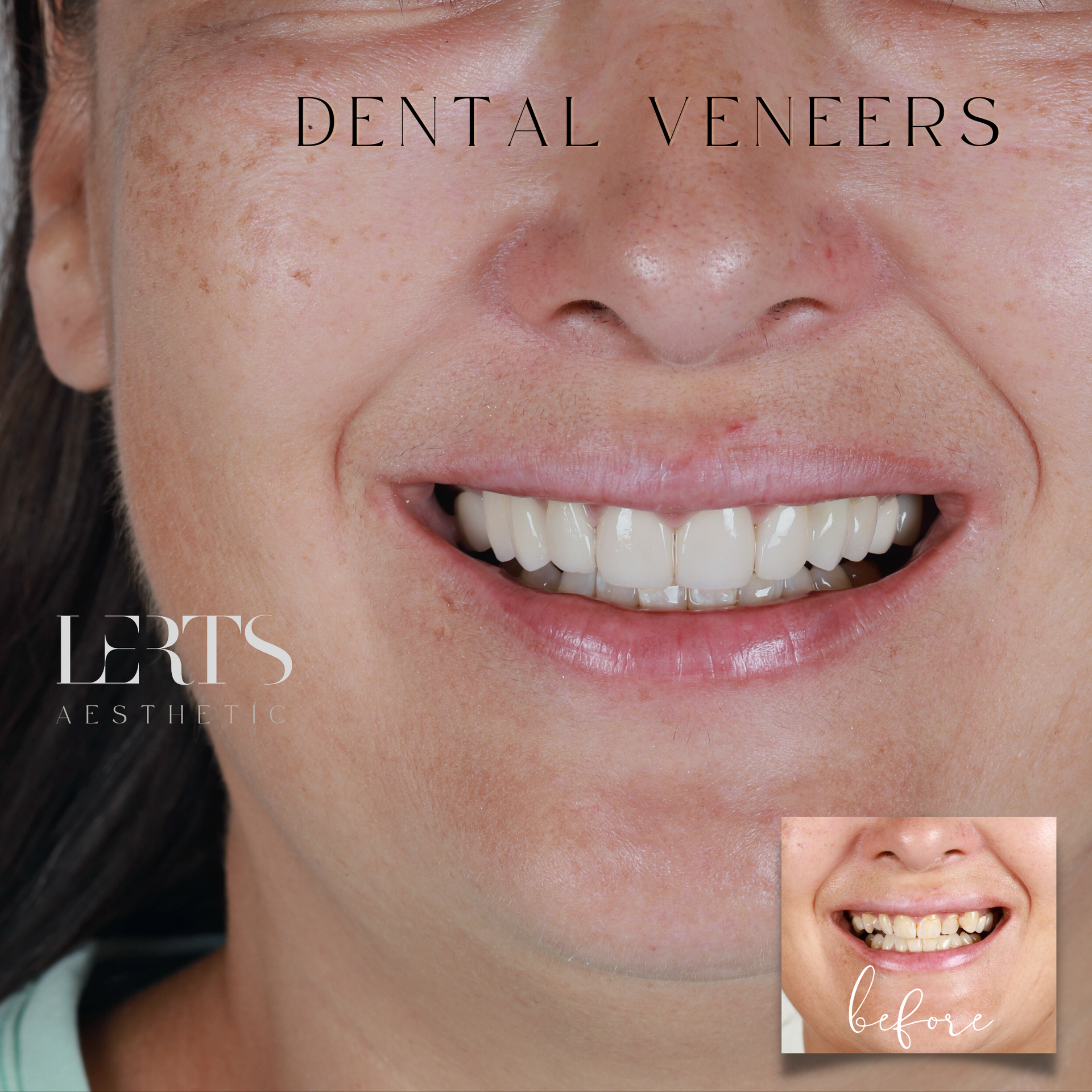 Woman smiling, teeth after dental veneers, before and after comparison.