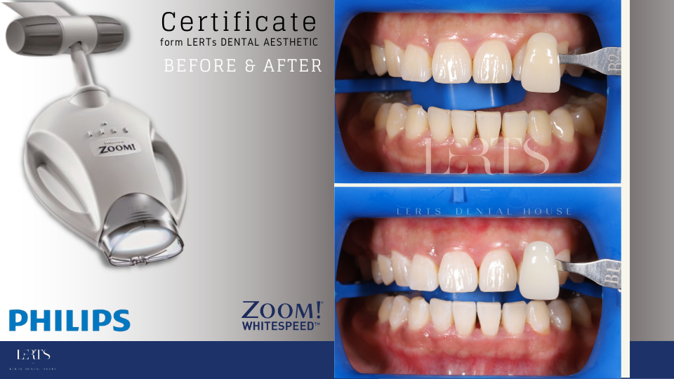Philips Zoom teeth whitening system, before & after teeth shade comparison.