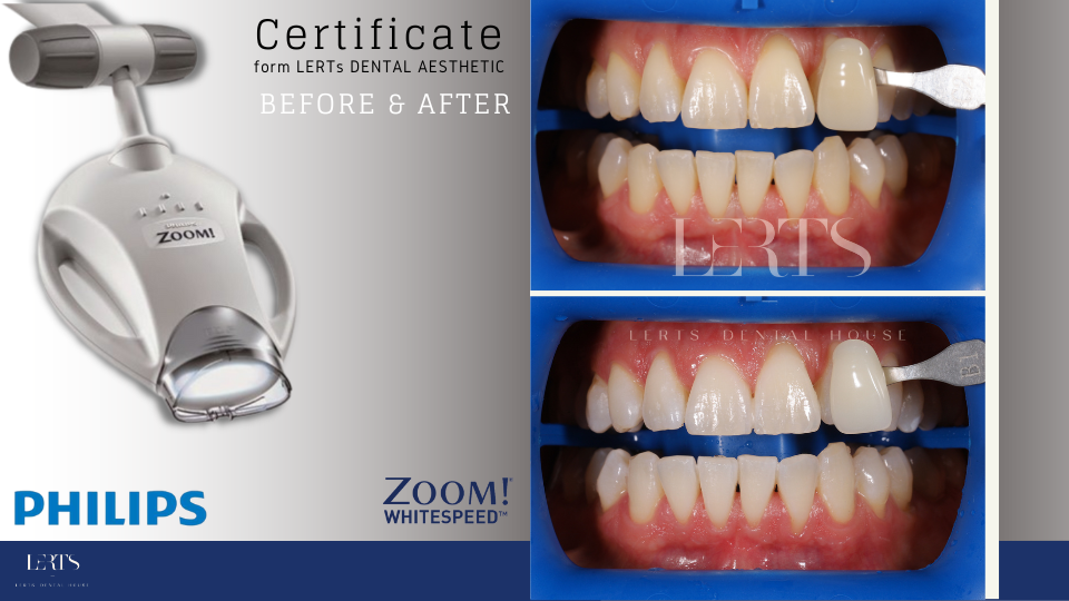 Philips Zoom teeth whitening system with before & after teeth shade comparison.