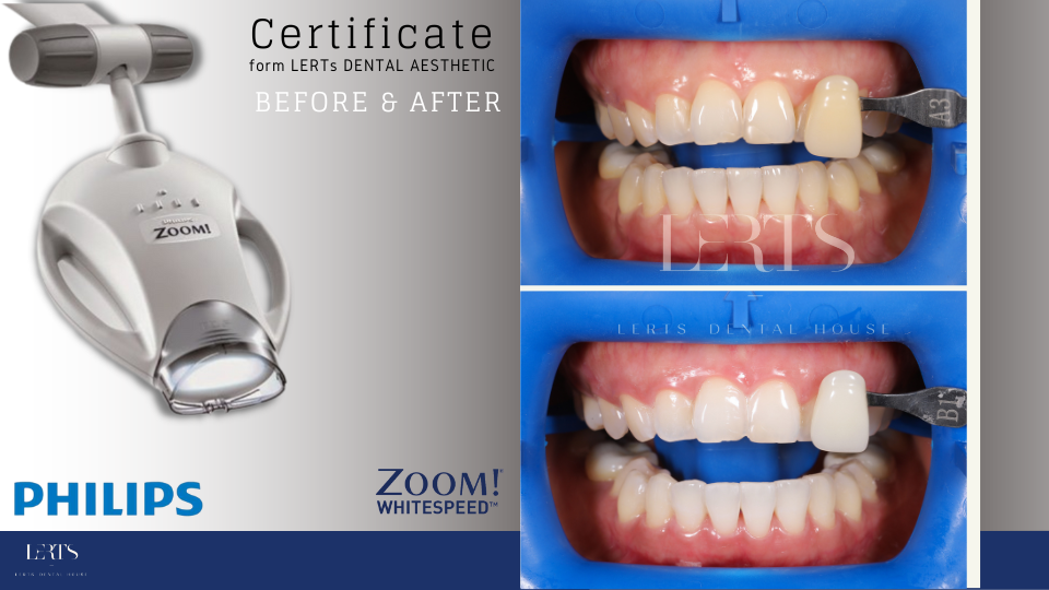 Philips Zoom teeth whitening machine; before & after tooth color comparison.