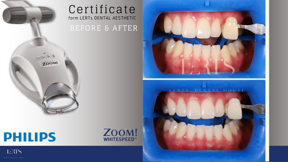 Philips Zoom teeth whitening system showing before and after results, comparing tooth shade.