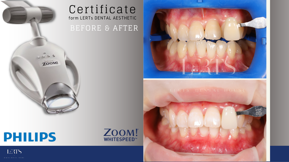 Philips Zoom teeth whitening equipment and before/after photos showing whiter teeth.