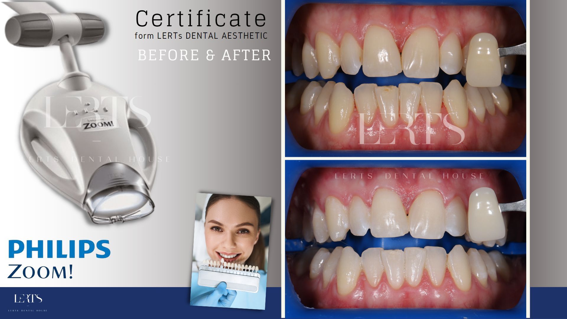 Philips Zoom whitening advertisement, shows before/after teeth whitening results; a woman and the whitening device.