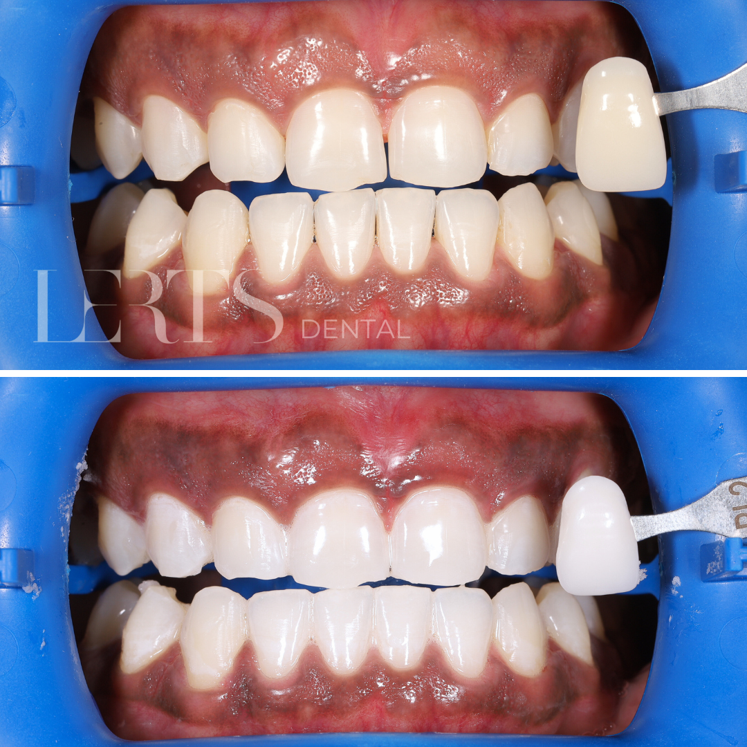 Before and after teeth whitening comparison; showing brighter teeth.