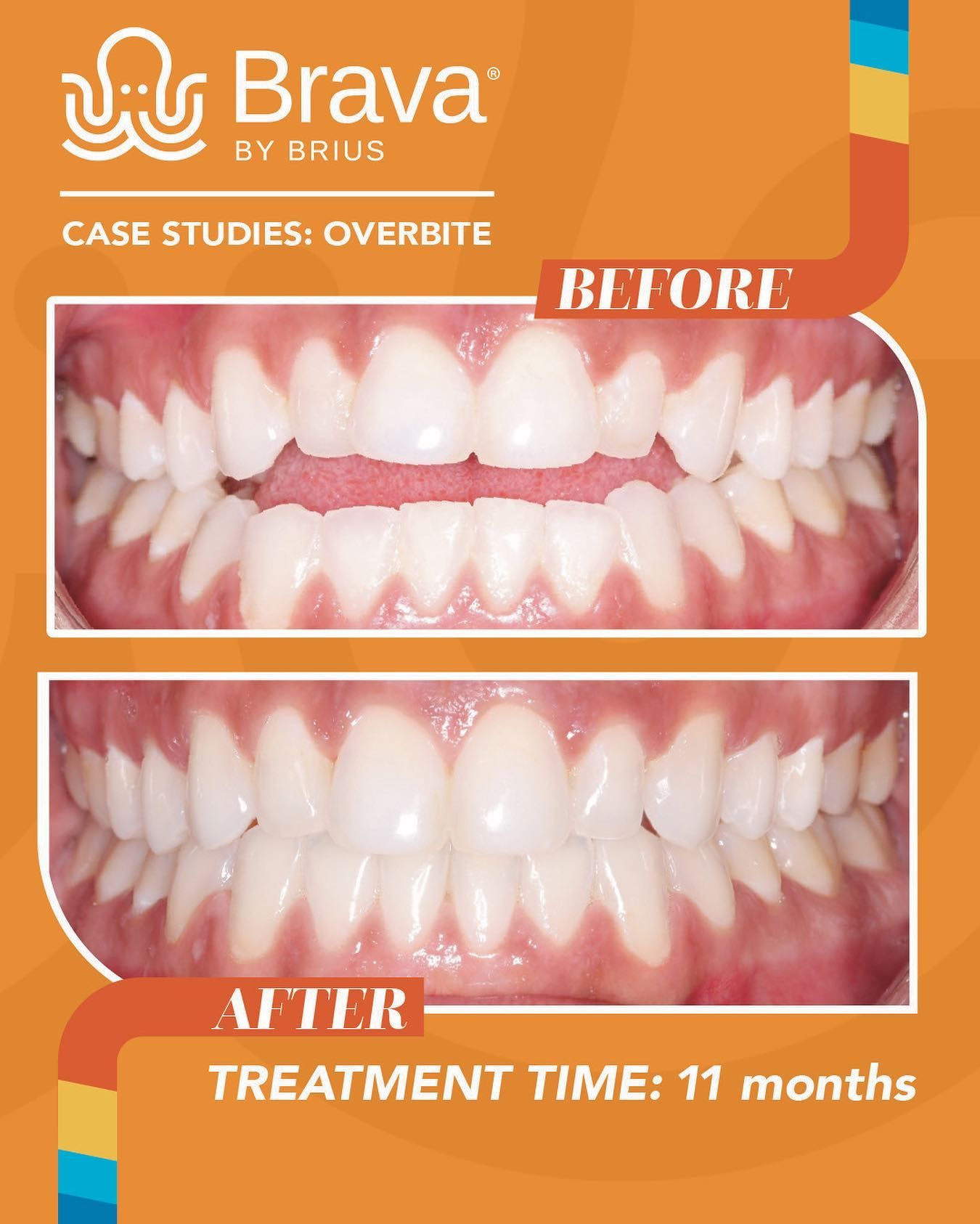 Teeth before/after Brava treatment for overbite. Before: Upper teeth overlap lower. After: Aligned. Treatment time: 11 months.