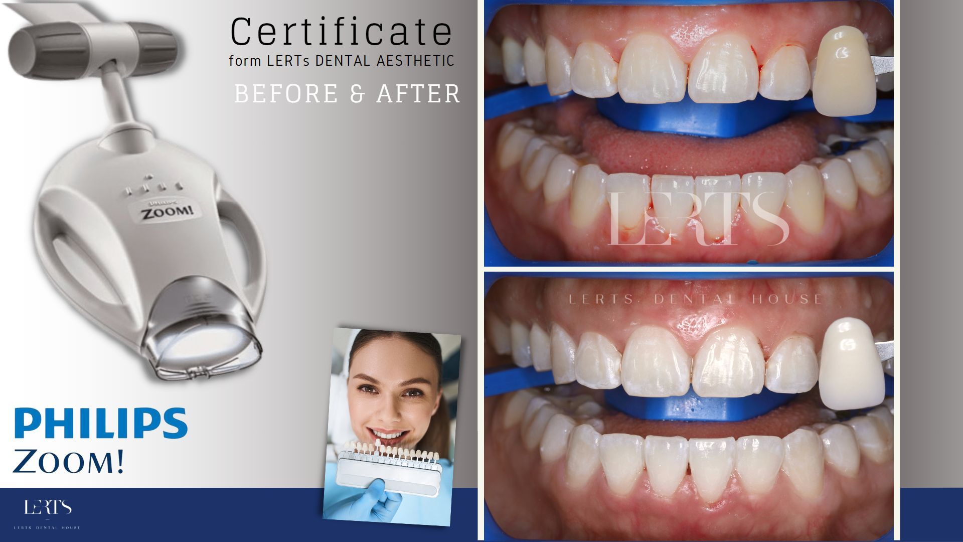 Philips Zoom whitening device with before/after teeth whitening comparisons.