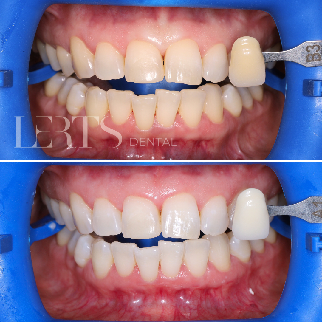 Before and after teeth whitening comparison. Top: yellow teeth. Bottom: white teeth. Shade guide next to front teeth.