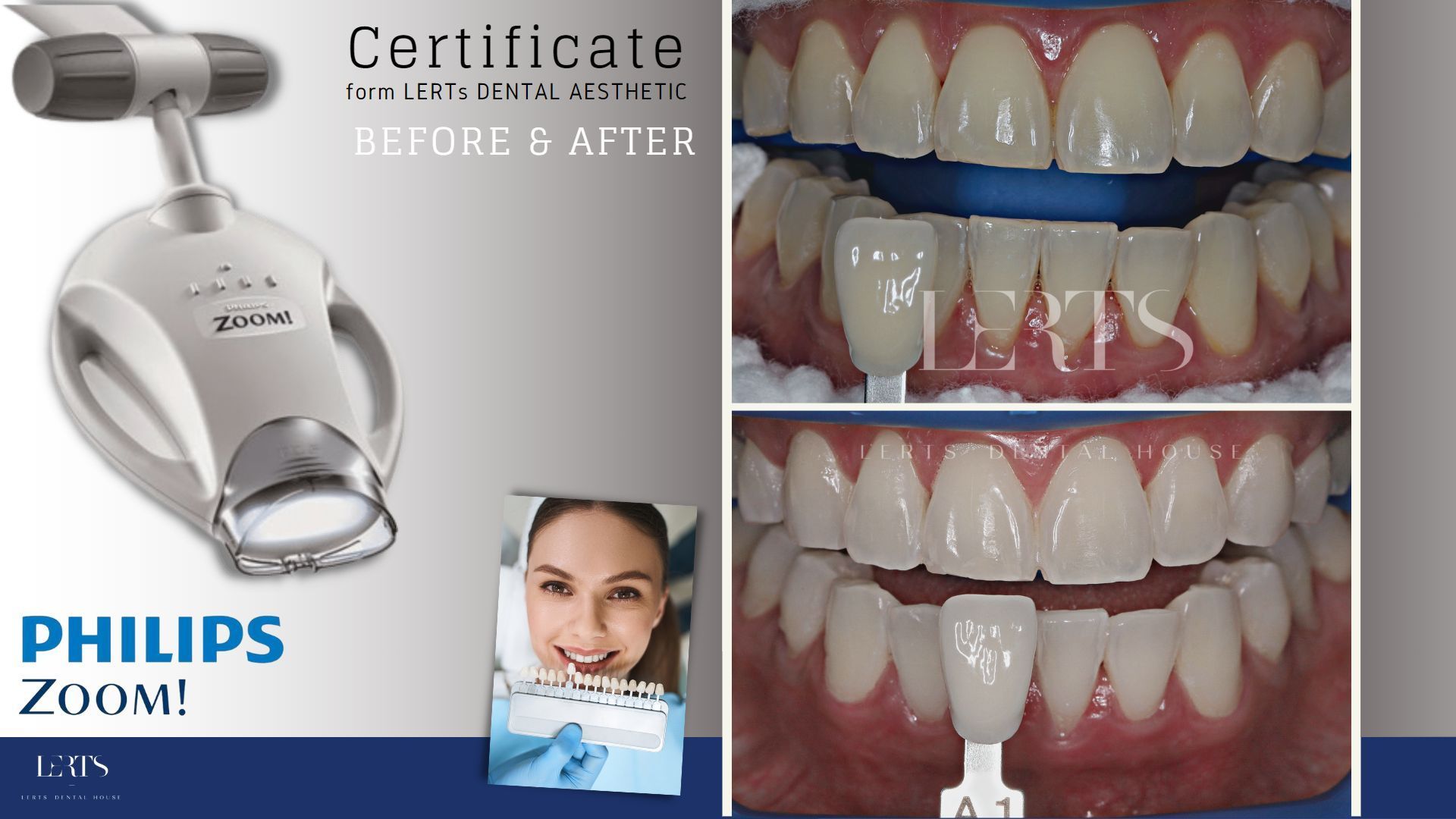 Philips Zoom teeth whitening equipment with before/after dental shade comparison.
