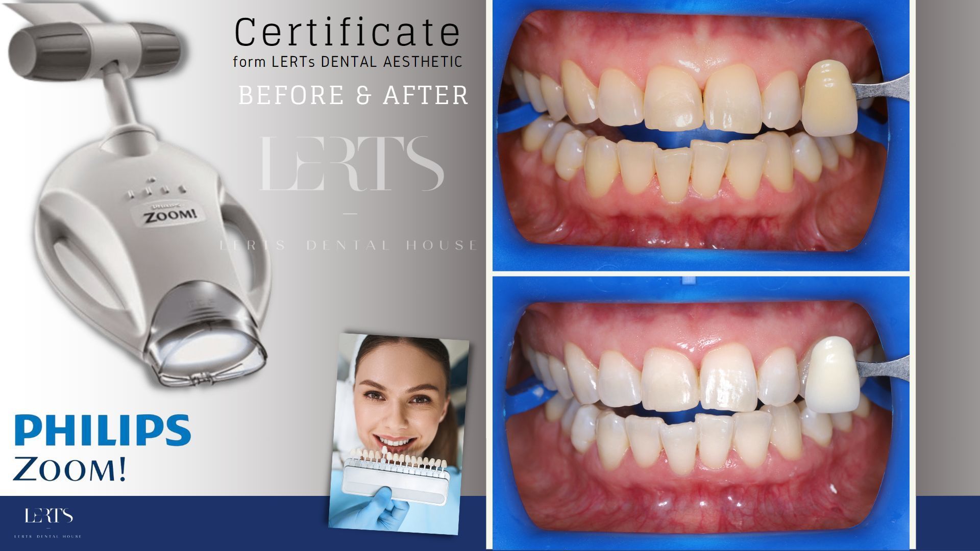 Philips Zoom teeth whitening device and 