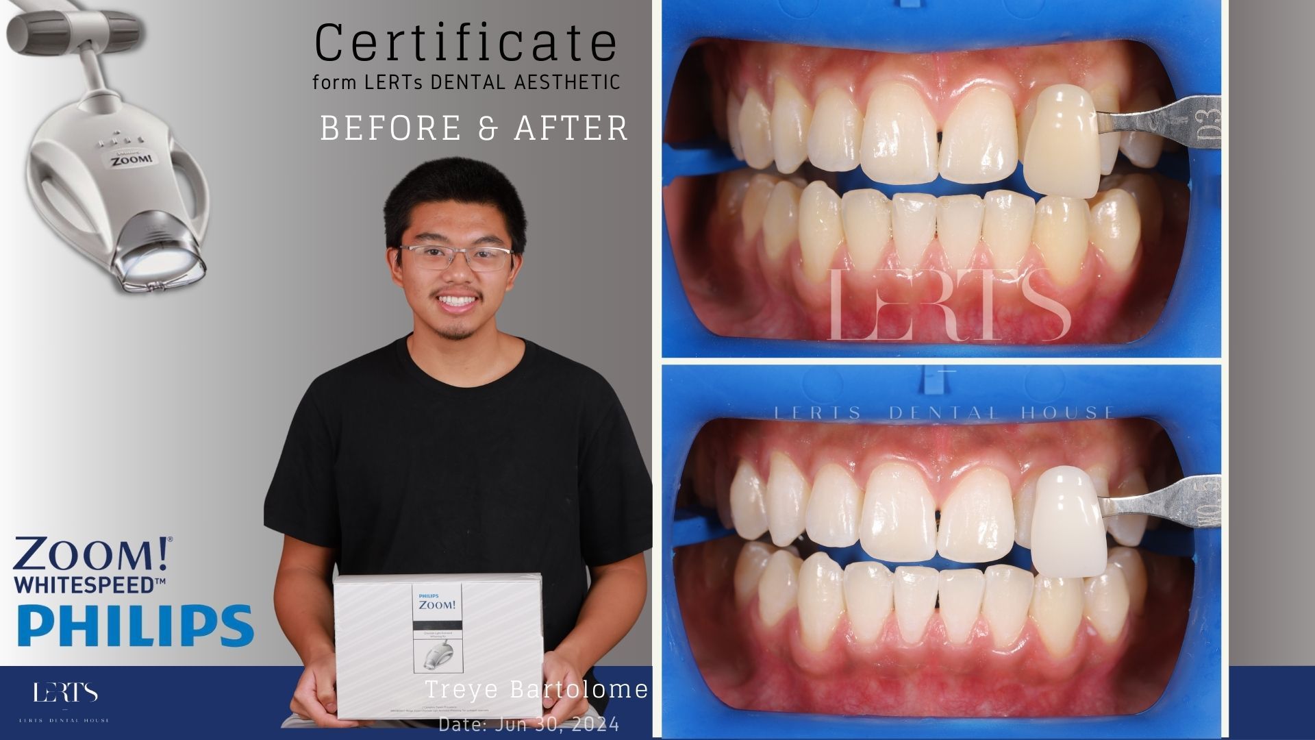 Man holding a certificate with before/after teeth whitening results, comparing shades.