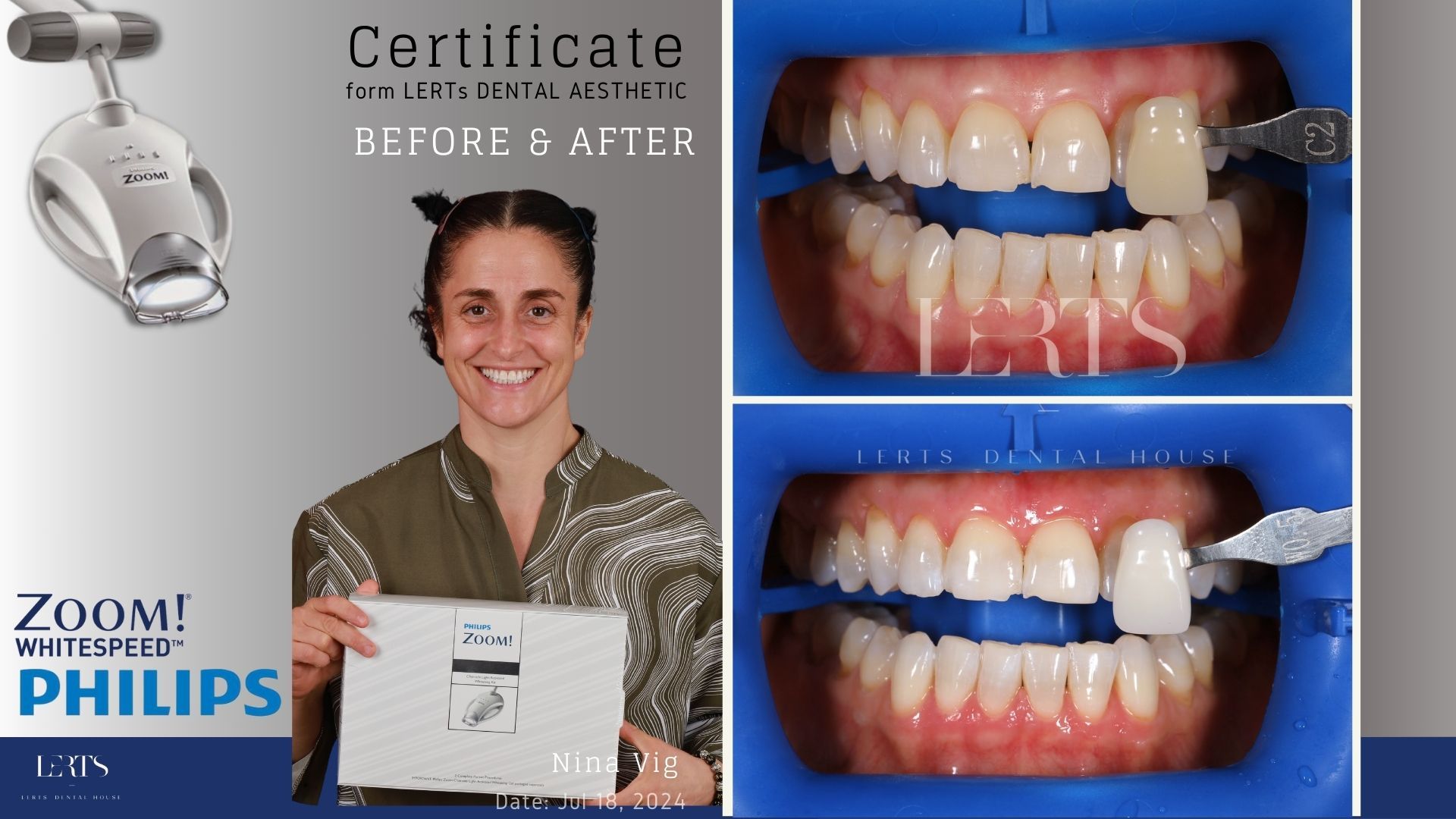 Woman showing teeth whitening results. Side-by-side photos and Zoom! Philips light.