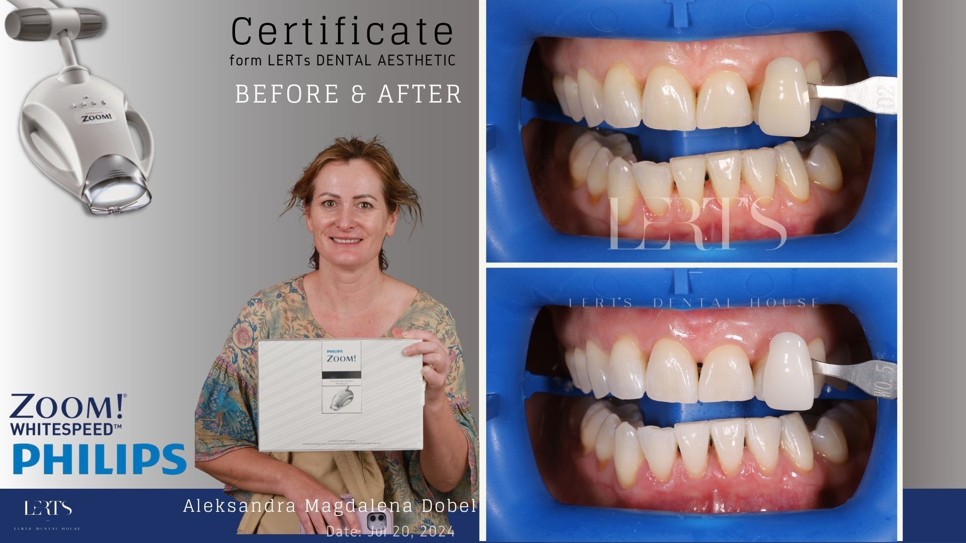 Woman showing a tooth whitening certificate, before and after shots of teeth whitening.
