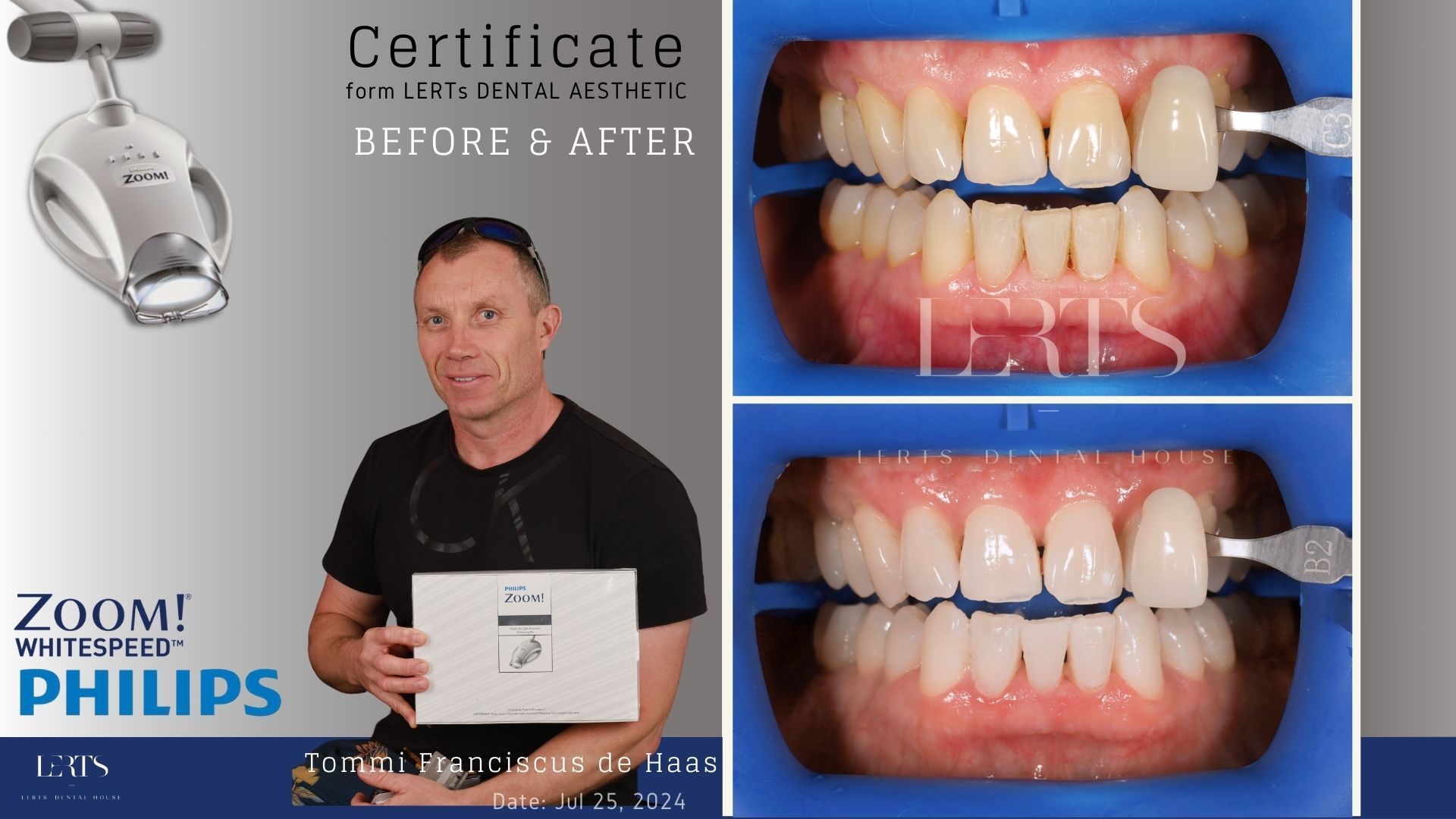 Man with whiter teeth after using Philips Zoom! teeth whitening. Comparison before/after photos.