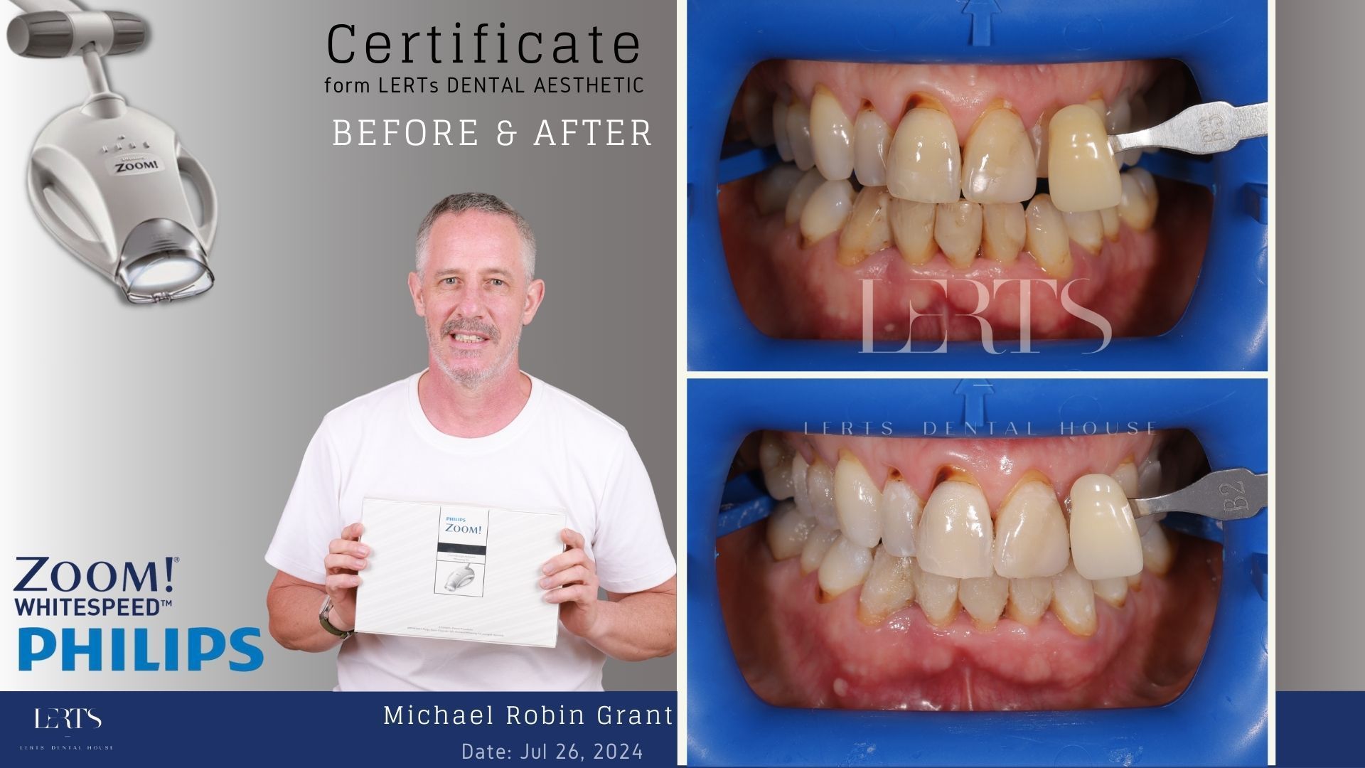Man smiling, holding white card with teeth whitening before/after photos. Zoom! Philips logo.
