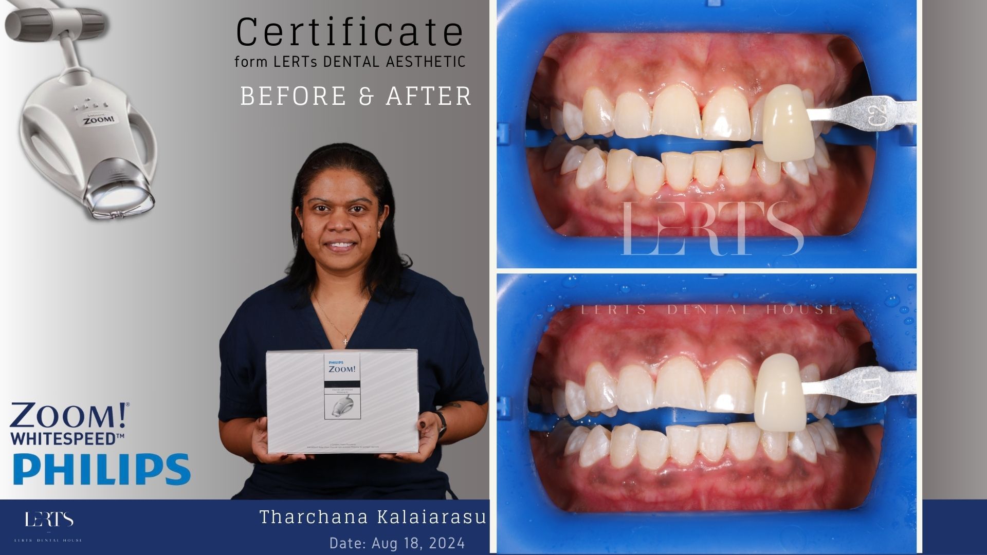 Woman holding a certificate for teeth whitening. Before/after shots show tooth shade changes with a whitening machine.