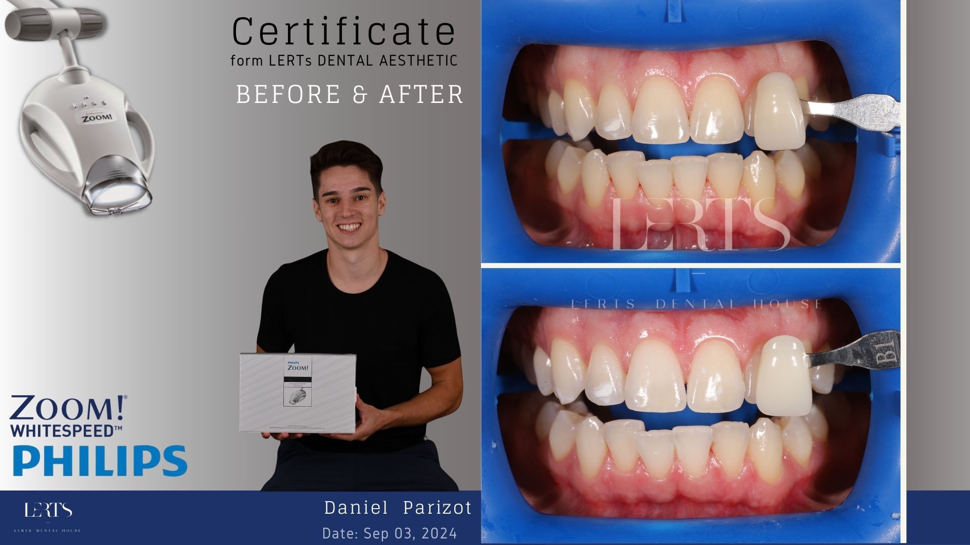 A man with a bright smile after a teeth whitening procedure, shown with before/after teeth comparisons.