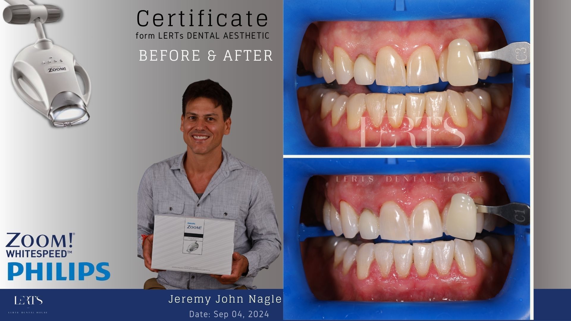 Man holding a white box, with before/after teeth whitening photos. Zoom teeth whitening product.