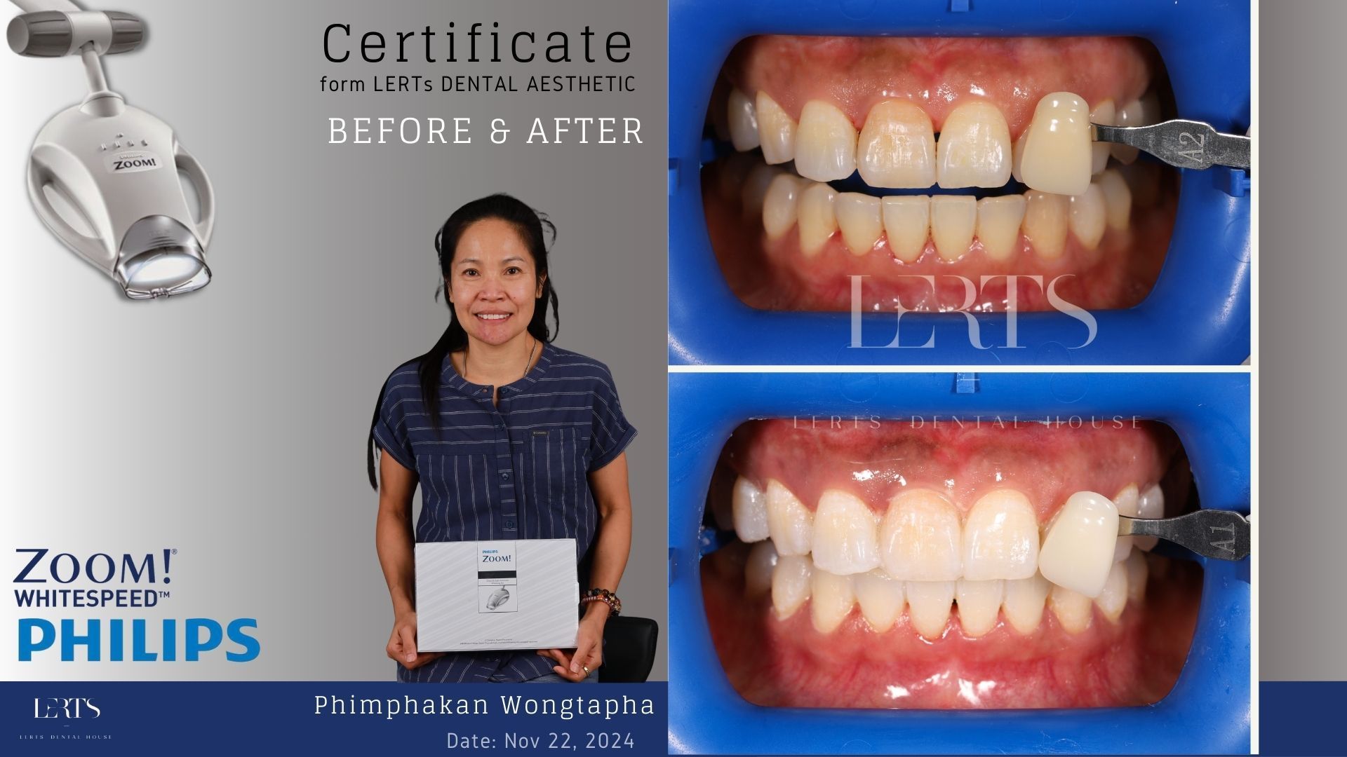 Woman with whitened teeth holding a card, before and after teeth whitening comparison.