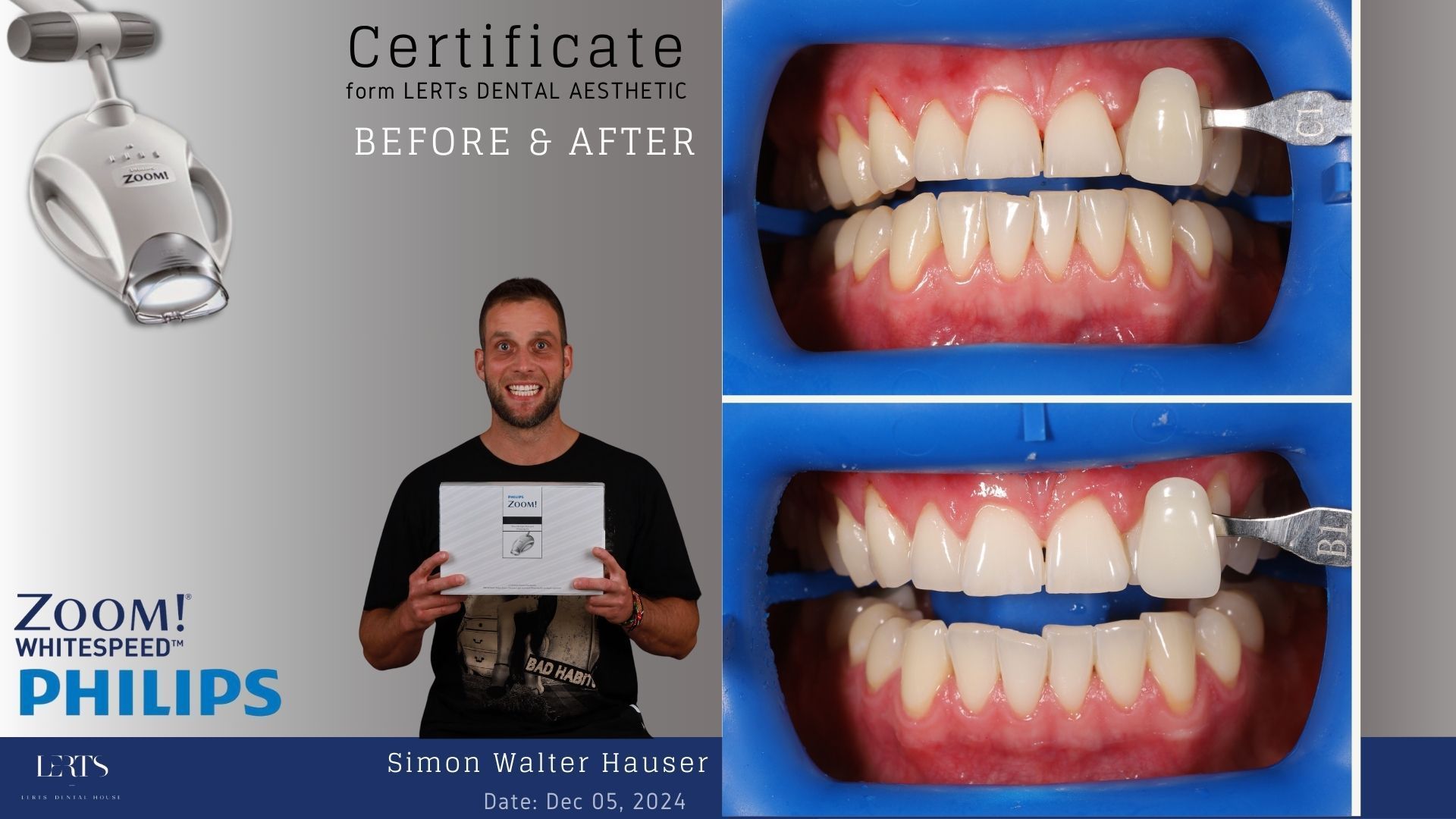 Man holding certificate, teeth whitening demonstration: before & after. Whitening machine.