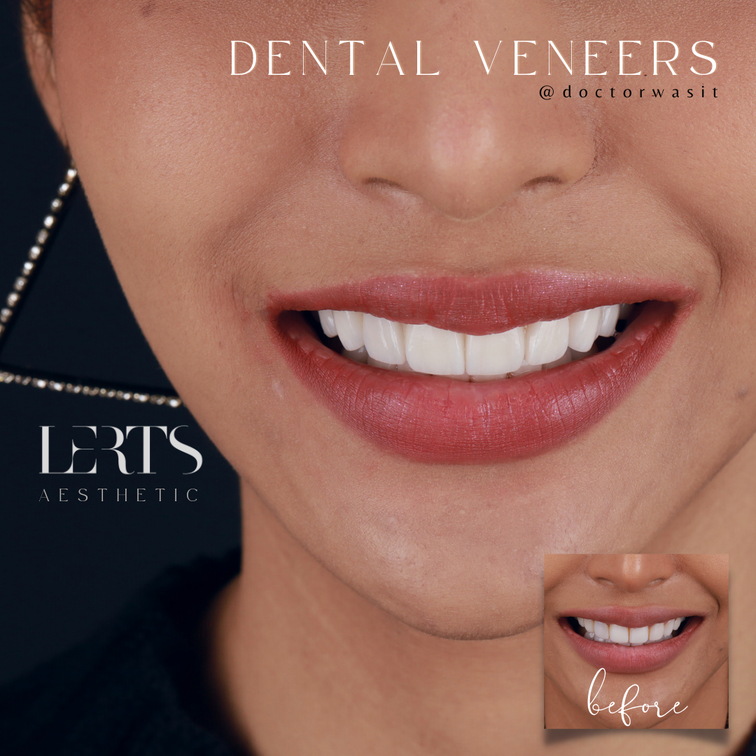 Close-up of a smiling woman with bright white dental veneers. A 