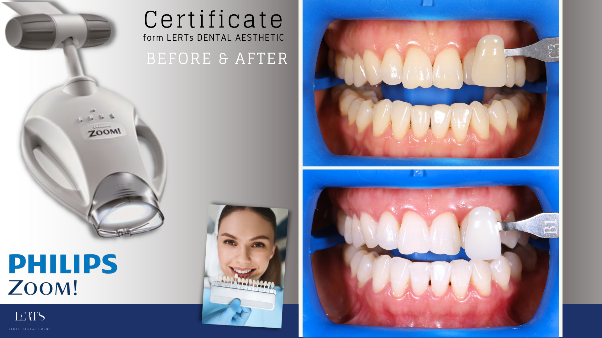 Philips Zoom whitening kit with before and after teeth whitening comparison.