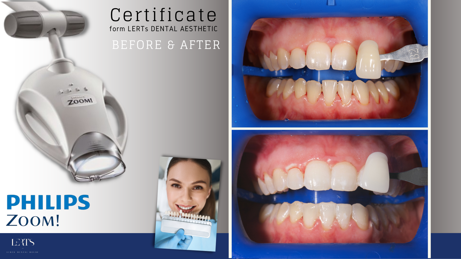 Philips Zoom teeth whitening system: device, before/after teeth whitening comparison.
