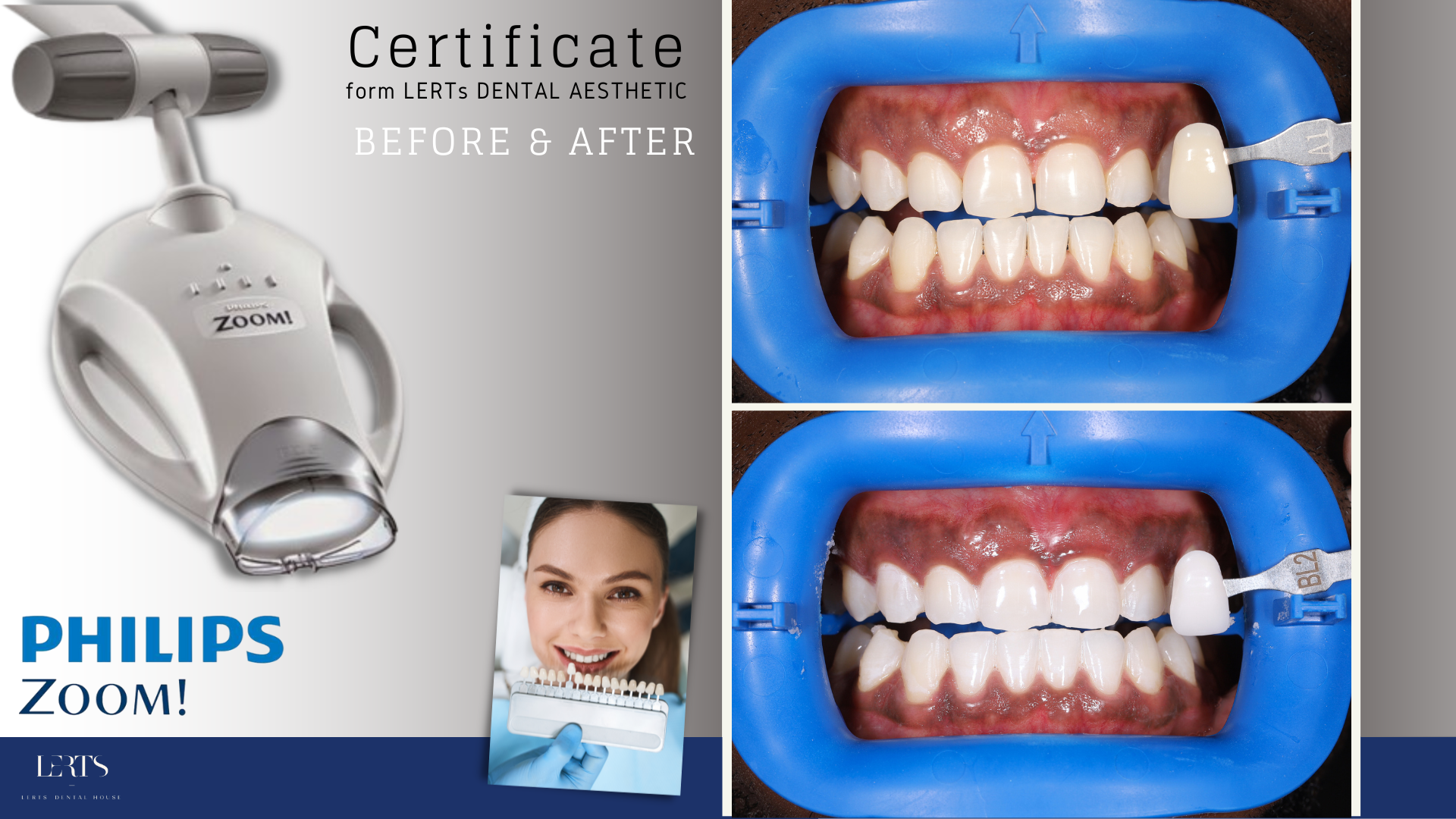 Philips Zoom teeth whitening procedure. Light device, before/after photos of teeth, dental tool for shade comparison.